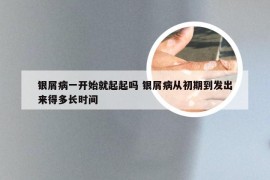 银屑病一开始就起起吗 银屑病从初期到发出来得多长时间