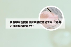 长春哪家医院看银屑病最权威的专家 长春专治银屑病医院哪个好