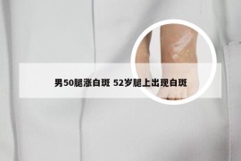 男50腿涨白斑 52岁腿上出现白斑