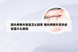 额头两侧长癣是怎么回事 额头两侧长很多痘痘是什么原因