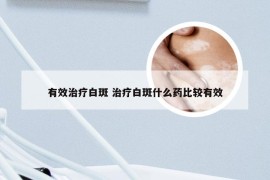 有效治疗白斑 治疗白斑什么药比较有效