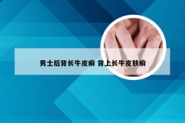 男士后背长牛皮癣 背上长牛皮肤癣