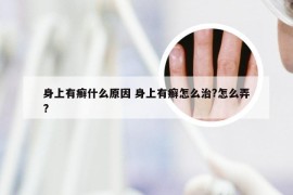 身上有癣什么原因 身上有癣怎么治?怎么弄?