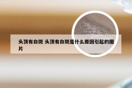 头顶有白斑 头顶有白斑是什么原因引起的图片