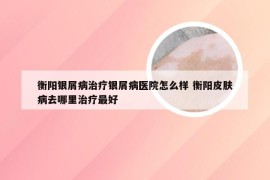 衡阳银屑病治疗银屑病医院怎么样 衡阳皮肤病去哪里治疗最好