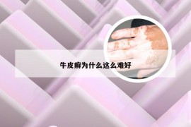 牛皮癣为什么这么难好