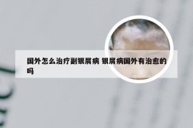 国外怎么治疗副银屑病 银屑病国外有治愈的吗