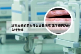 涂完治癣的药为什么会起泡呢 涂了癣药为什么特别痒