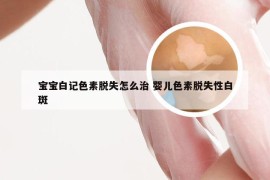 宝宝白记色素脱失怎么治 婴儿色素脱失性白斑