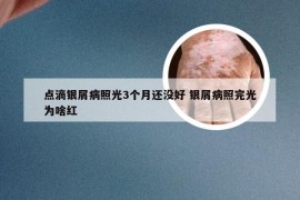 点滴银屑病照光3个月还没好 银屑病照完光为啥红