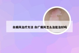 白癜风治疗方法 白疒癜风怎么治能治好吗