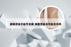 细菌感染引起牛皮癣 细菌感染会引起皮炎吗