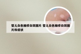 婴儿白色糠疹白斑图片 婴儿白色糠疹白斑图片和症状