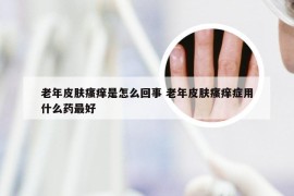 老年皮肤瘙痒是怎么回事 老年皮肤瘙痒症用什么药最好