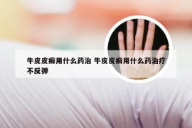 牛皮皮癣用什么药治 牛皮皮癣用什么药治疗不反弹