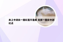 身上中间白一圈红是不是癣 皮肤一圈白中间红点