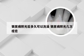 银屑病照光后多久可以洗澡 银屑病照光几次痊愈