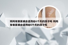 妈妈有银屑病会遗传给6个月的孩子吗 妈妈有银屑病会遗传给6个月的孩子吗