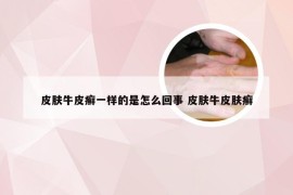 皮肤牛皮癣一样的是怎么回事 皮肤牛皮肤癣