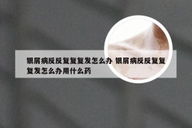 银屑病反反复复复发怎么办 银屑病反反复复复发怎么办用什么药