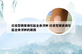 红皮型银屑病引起全身浮肿 红皮型银屑病引起全身浮肿的原因