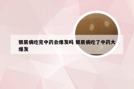 银屑病吃完中药会爆发吗 银屑病吃了中药大爆发