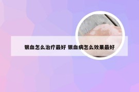 银血怎么治疗最好 银血病怎么效果最好