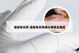 面部有白斑 面部有白斑细小鳞屑且瘙痒