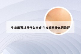 牛皮廨可以用什么治好 牛皮廨用什么药最好