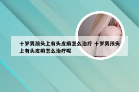 十岁男孩头上有头皮癣怎么治疗 十岁男孩头上有头皮癣怎么治疗呢