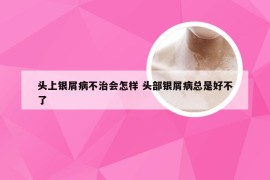 头上银屑病不治会怎样 头部银屑病总是好不了