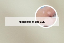 银屑病液氮 银屑病 uvb