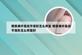 银屑病手指关节变形怎么恢复 银屑病手指关节变形怎么恢复好