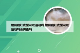 银屑病红皮型可以运动吗 银屑病红皮型可以运动吗会传染吗