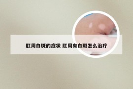 肛周白斑的症状 肛周有白斑怎么治疗