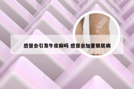 感冒会引发牛皮癣吗 感冒会加重银屑病