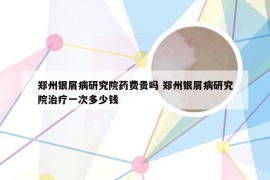 郑州银屑病研究院药费贵吗 郑州银屑病研究院治疗一次多少钱