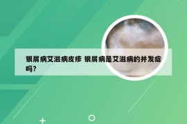 银屑病艾滋病皮疹 银屑病是艾滋病的并发症吗?