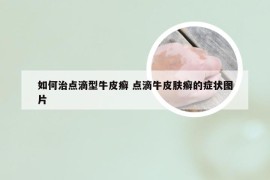 如何治点滴型牛皮癣 点滴牛皮肤癣的症状图片