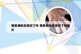 银屑病蜕皮就好了吗 银屑病蜕皮就好了吗图片