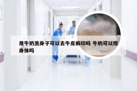 用牛奶洗身子可以去牛皮癣印吗 牛奶可以擦身体吗