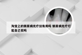 淘宝上的银屑病光疗仪有用吗 银屑病光疗灯能自己买吗