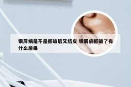 银屑病是不是抓破后又结皮 银屑病抓破了有什么后果