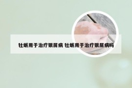 牡蛎用于治疗银屑病 牡蛎用于治疗银屑病吗