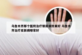 乌鲁木齐那个医院治疗银屑病效果好 乌鲁木齐治疗皮肤病哪家好