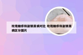 玫瑰糠疹和副银屑病对比 玫瑰糠疹和副银屑病区分图片