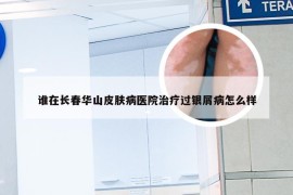 谁在长春华山皮肤病医院治疗过银屑病怎么样