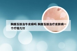 胸腺五肽治牛皮癣吗 胸腺五肽治疗皮肤病一个疗程几针